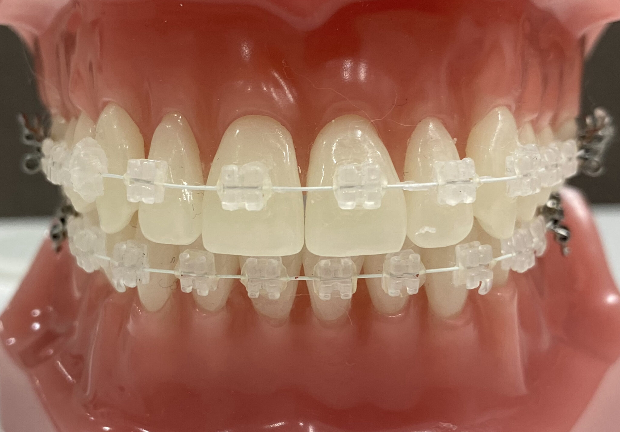 表側矯正のホワイトワイヤーについて｜福岡市中央区の薬院大通駅近くの矯正歯科